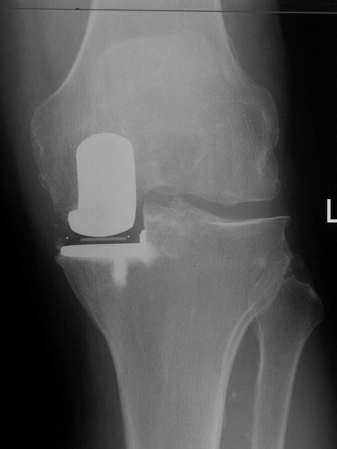 Partial-Knee-Replacement-2